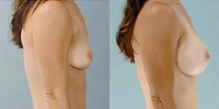 Before & After Breast Augmentation Case 4634 View 3 View in Houston, TX