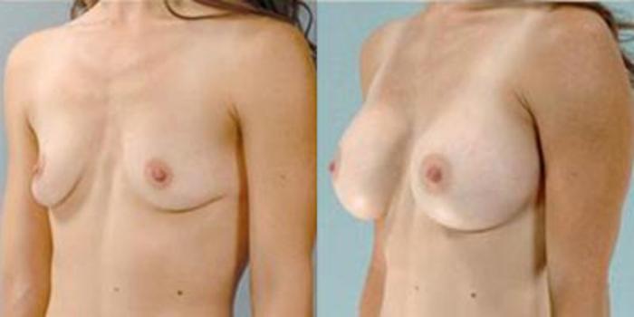 Before & After Breast Augmentation Case 4634 View 4 View in Houston, TX