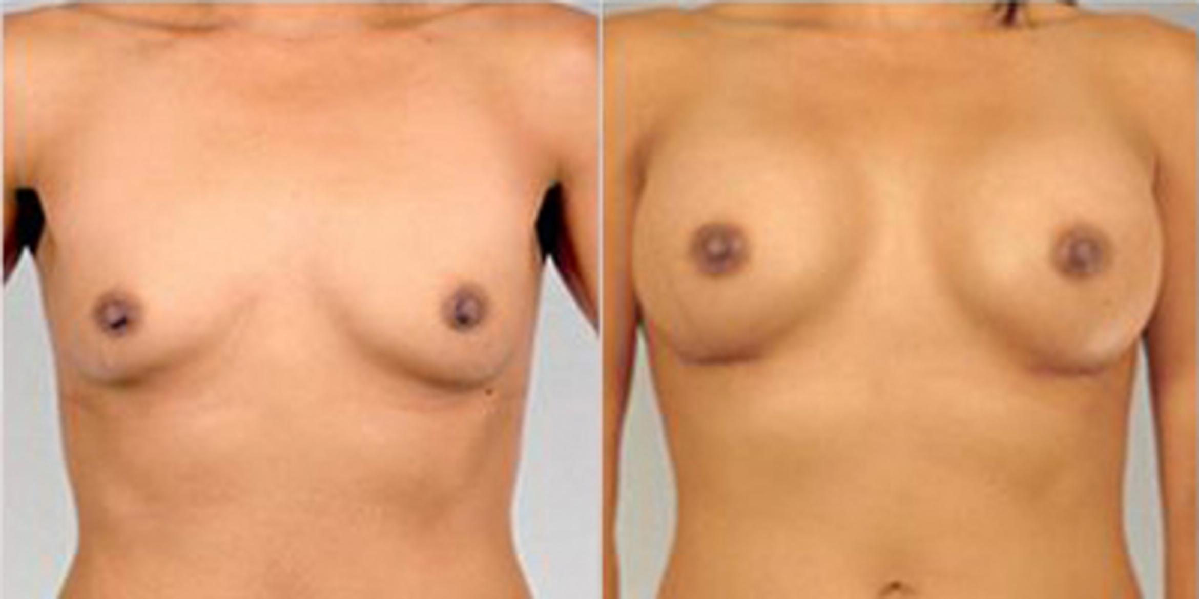 Before & After Breast Augmentation Case 4644 View 1 View in Houston, TX