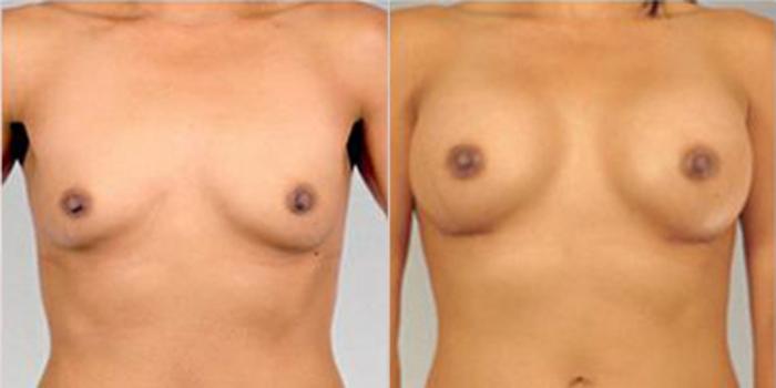 Before & After Breast Augmentation Case 4644 View 1 View in Houston, TX