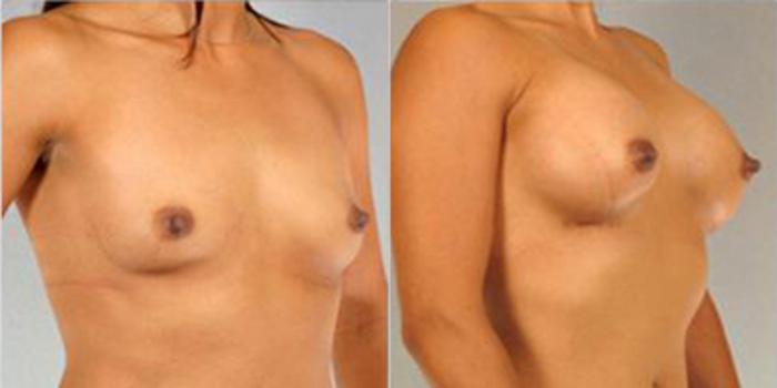 Before & After Breast Augmentation Case 4644 View 2 View in Houston, TX