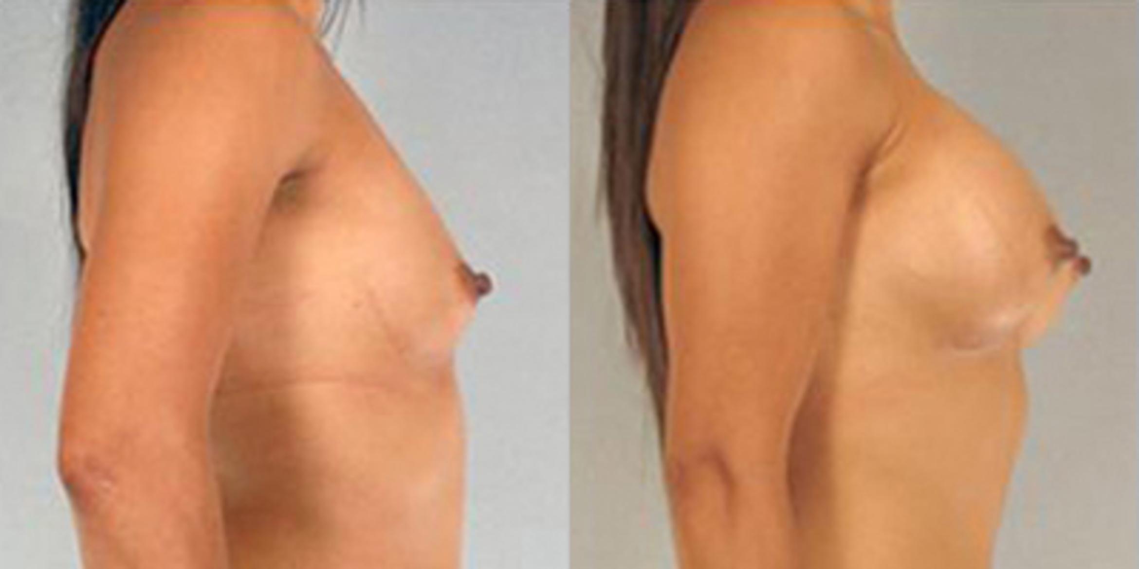 Before & After Breast Augmentation Case 4644 View 3 View in Houston, TX