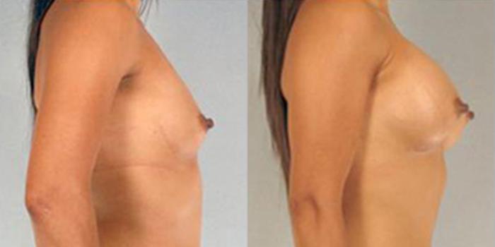 Before & After Breast Augmentation Case 4644 View 3 View in Houston, TX