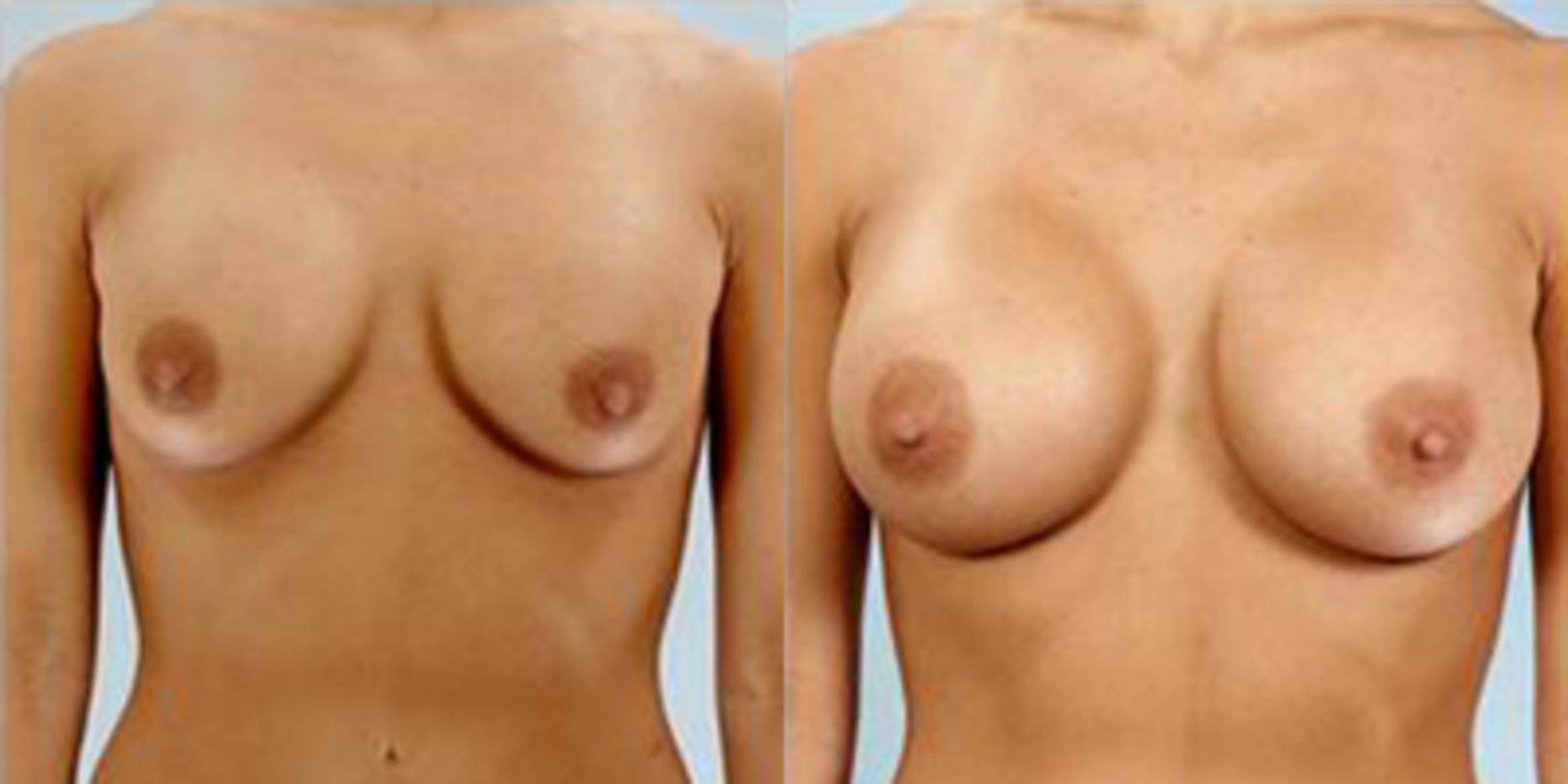 Before & After Breast Augmentation Case 4652 View 1 View in Houston, TX