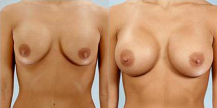 Before & After Breast Augmentation Case 4652 View 1 View in Houston, TX
