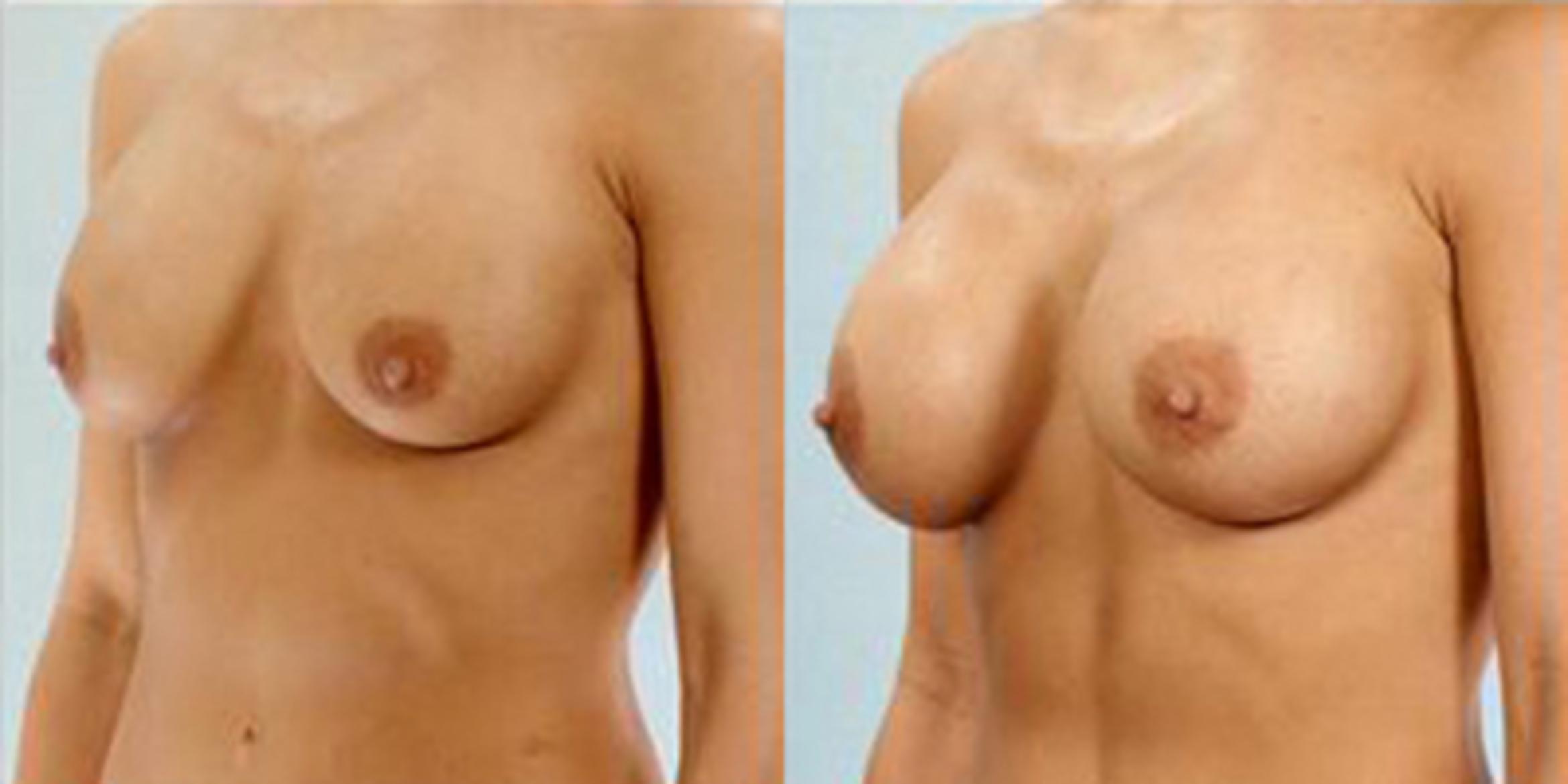 Before & After Breast Augmentation Case 4652 View 2 View in Houston, TX
