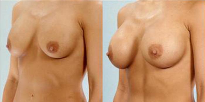 Before & After Breast Augmentation Case 4652 View 2 View in Houston, TX
