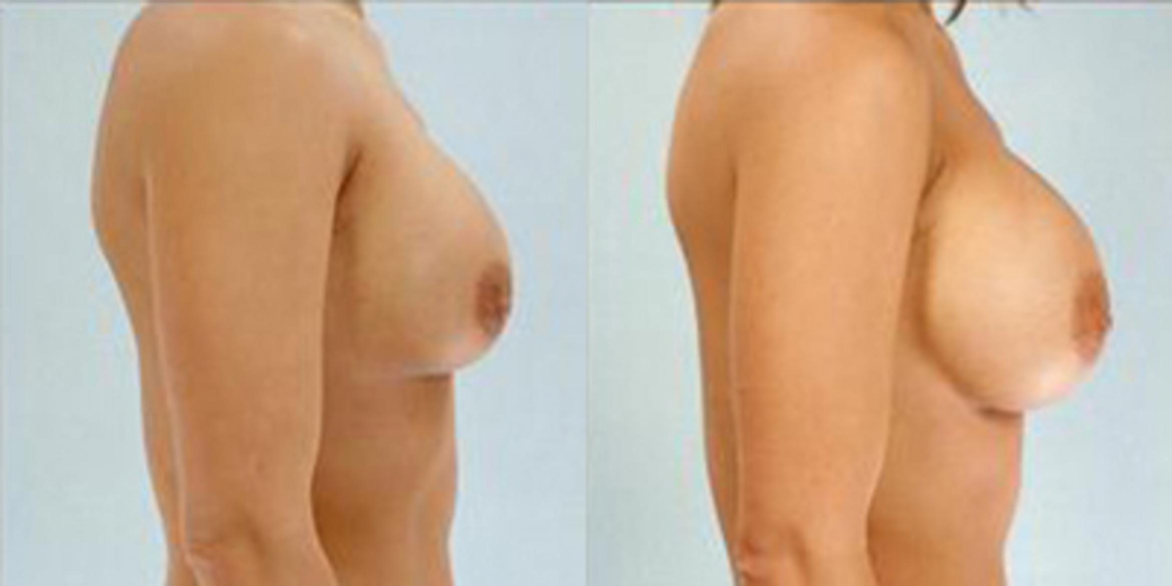 Before & After Breast Augmentation Case 4652 View 3 View in Houston, TX
