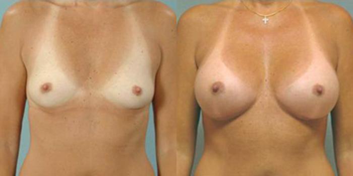 Before & After Breast Augmentation Case 4662 View 1 View in Houston, TX