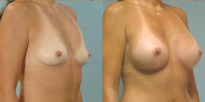 Before & After Breast Augmentation Case 4662 View 2 View in Houston, TX