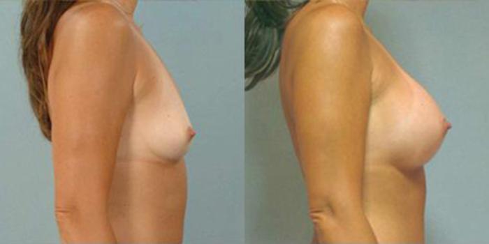 Before & After Breast Augmentation Case 4662 View 3 View in Houston, TX