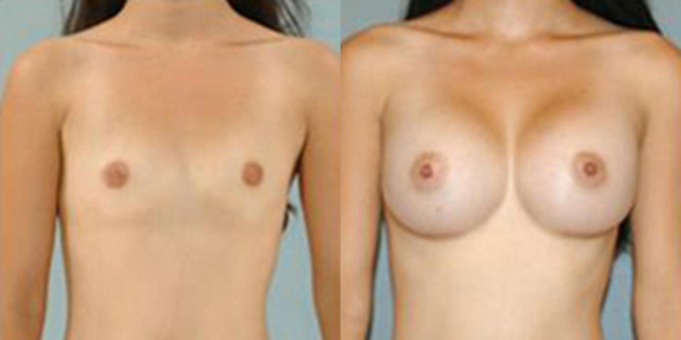 Before & After Breast Augmentation Case 4670 View 1 View in Houston, TX