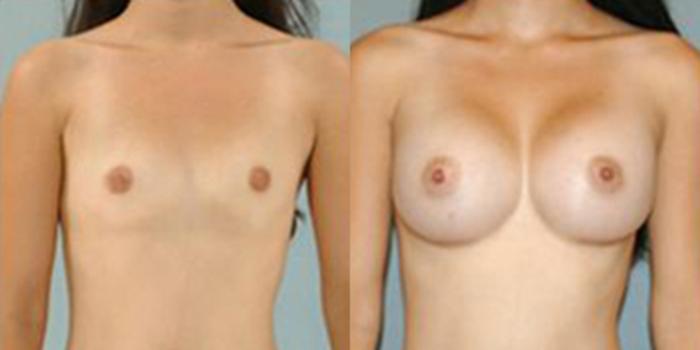 Before & After Breast Augmentation Case 4670 View 1 View in Houston, TX