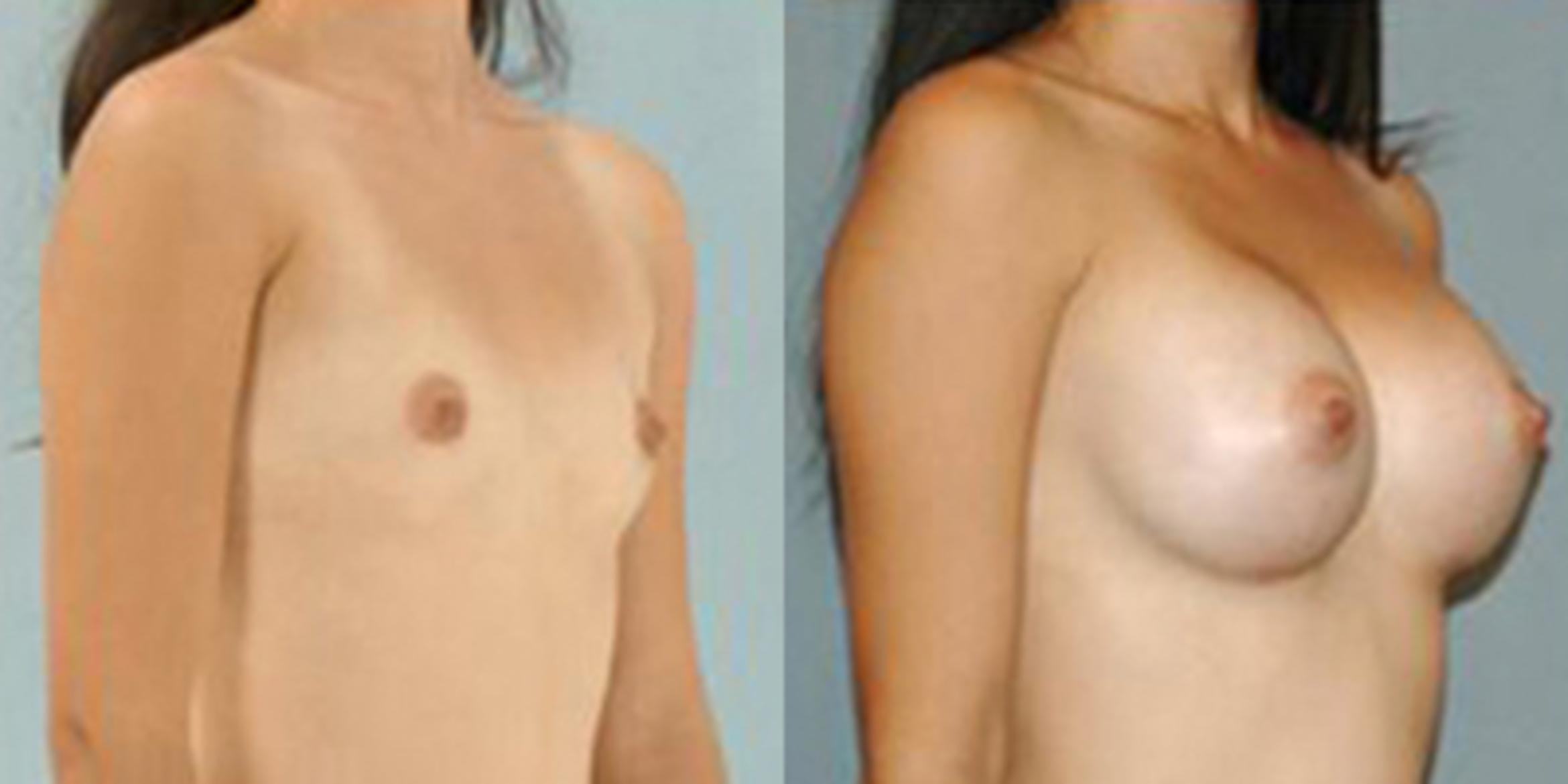 Before & After Breast Augmentation Case 4670 View 2 View in Houston, TX
