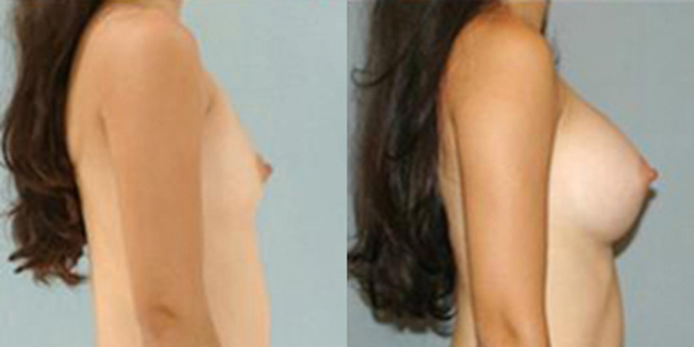Before & After Breast Augmentation Case 4670 View 3 View in Houston, TX