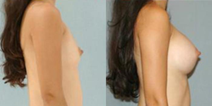 Before & After Breast Augmentation Case 4670 View 3 View in Houston, TX
