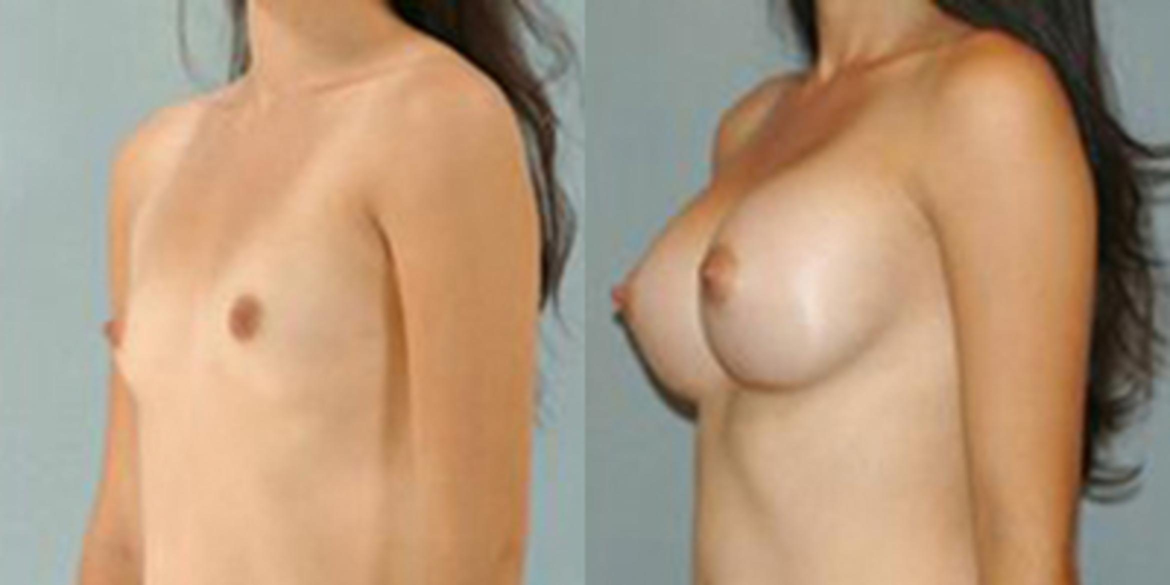 Before & After Breast Augmentation Case 4670 View 4 View in Houston, TX