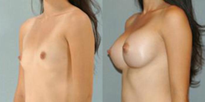 Before & After Breast Augmentation Case 4670 View 4 View in Houston, TX