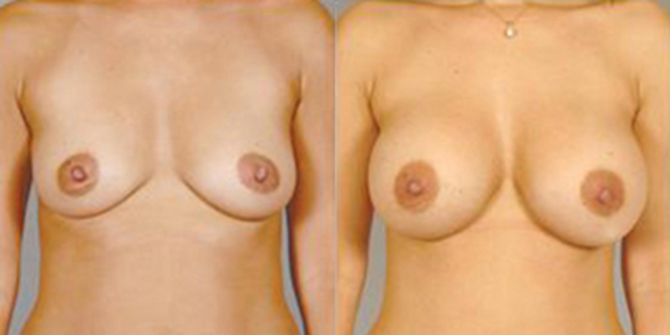 Before & After Breast Augmentation Case 4680 View 1 View in Houston, TX