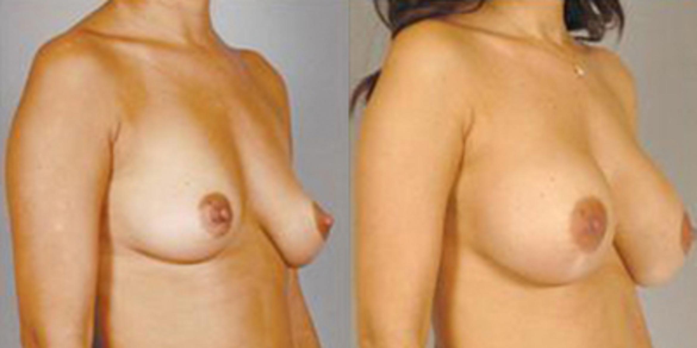 Before & After Breast Augmentation Case 4680 View 2 View in Houston, TX