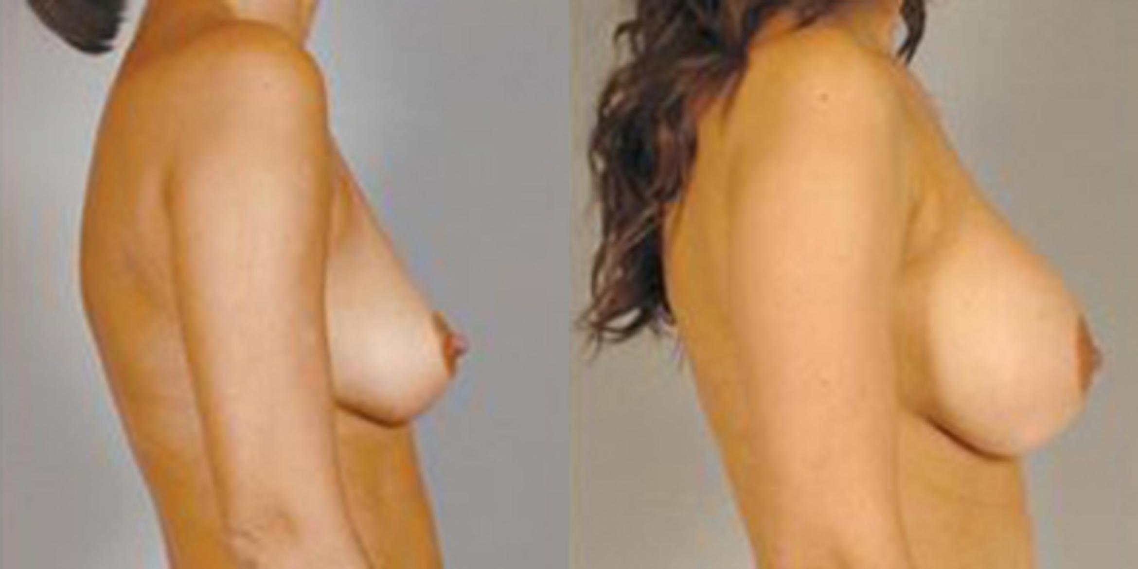 Before & After Breast Augmentation Case 4680 View 3 View in Houston, TX