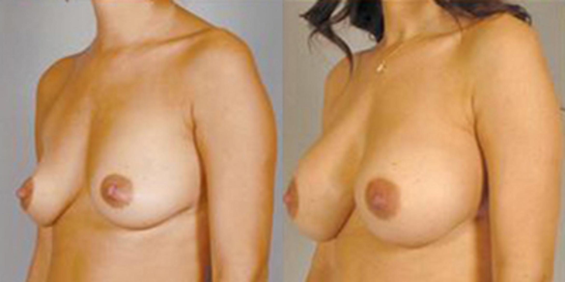Before & After Breast Augmentation Case 4680 View 4 View in Houston, TX