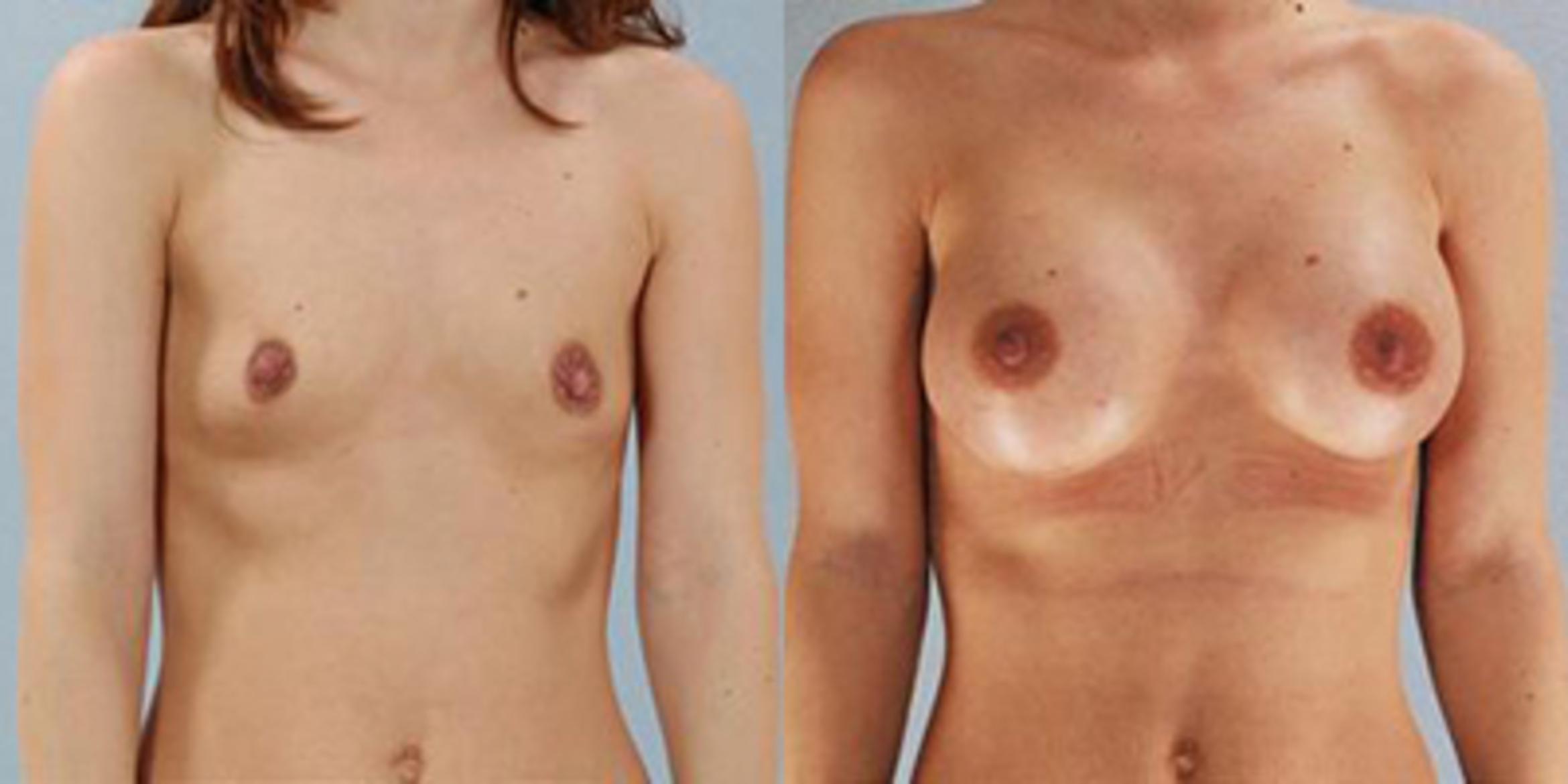 Before & After Breast Augmentation Case 4690 View 1 View in Houston, TX