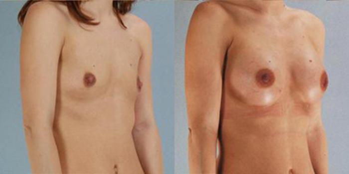 Before & After Breast Augmentation Case 4690 View 2 View in Houston, TX
