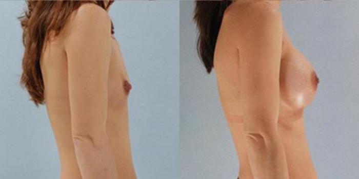 Before & After Breast Augmentation Case 4690 View 3 View in Houston, TX