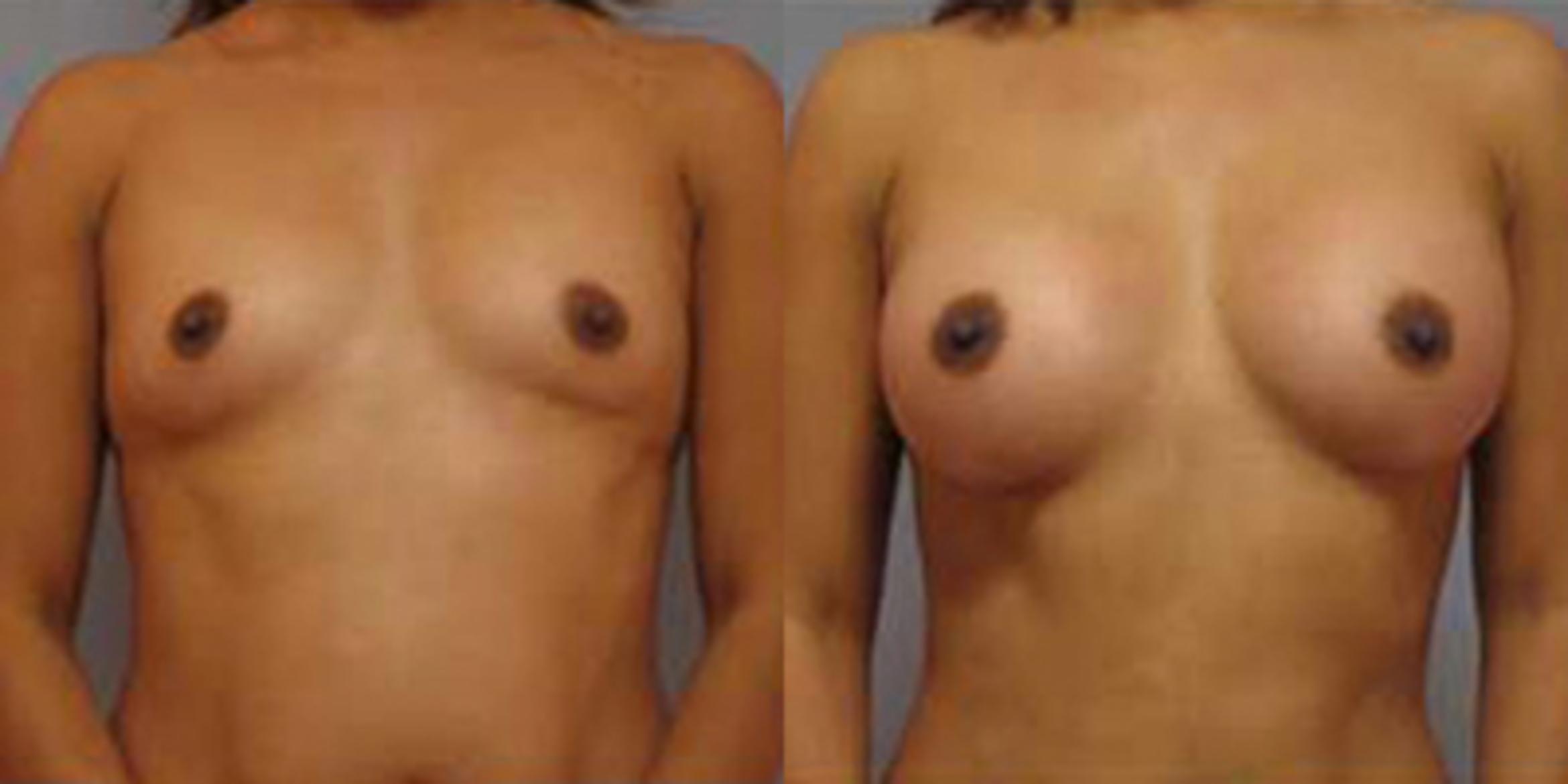 Before & After Breast Augmentation Case 4698 View 1 View in Houston, TX