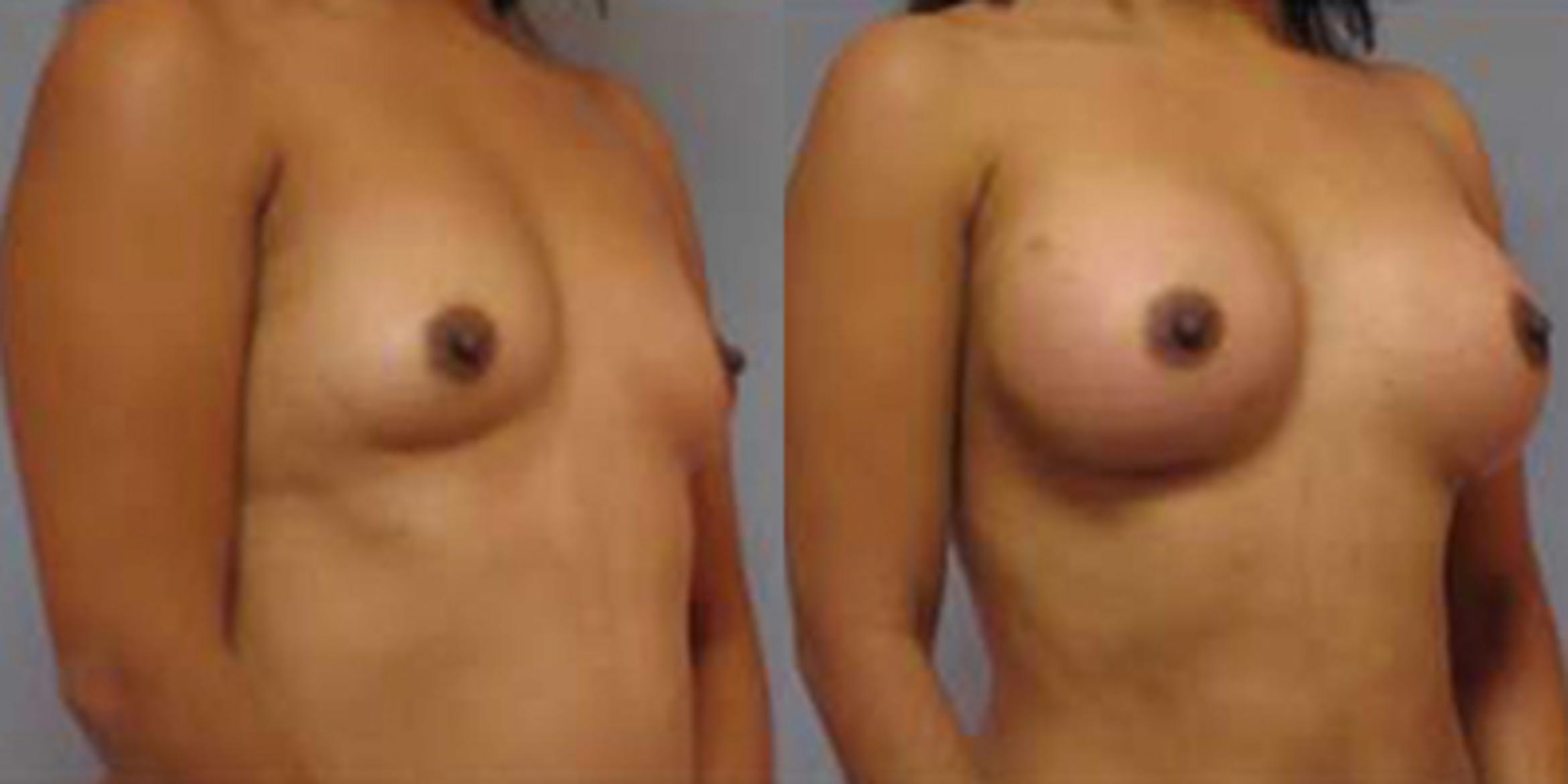 Before & After Breast Augmentation Case 4698 View 2 View in Houston, TX