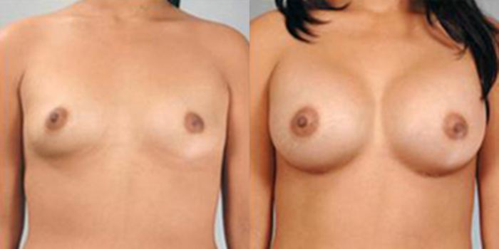 Before & After Breast Augmentation Case 4706 View 1 View in Houston, TX