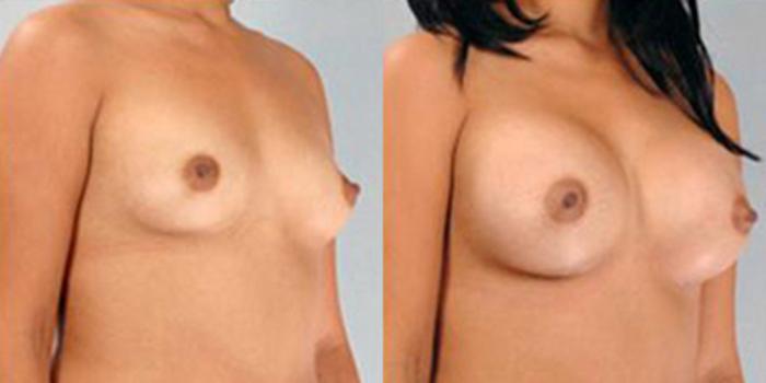 Before & After Breast Augmentation Case 4706 View 2 View in Houston, TX