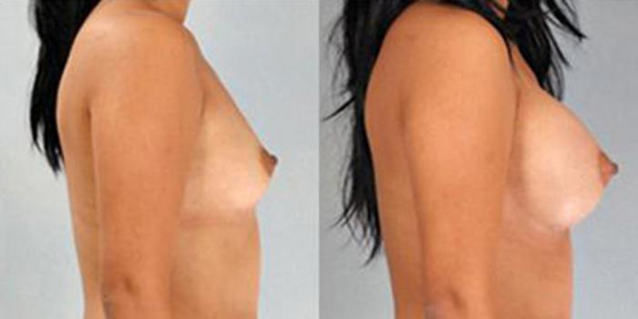 Before & After Breast Augmentation Case 4706 View 3 View in Houston, TX