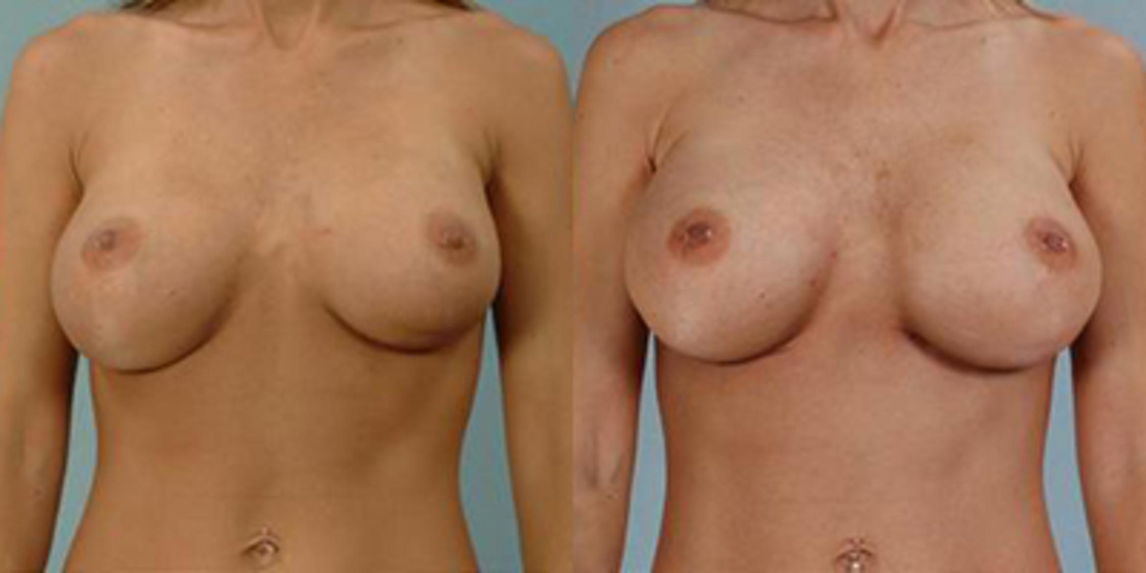Before & After Breast Augmentation Case 4714 View 1 View in Houston, TX