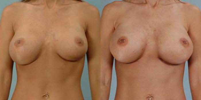 Before & After Breast Augmentation Case 4714 View 1 View in Houston, TX