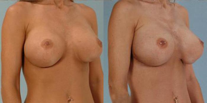 Before & After Breast Augmentation Case 4714 View 2 View in Houston, TX