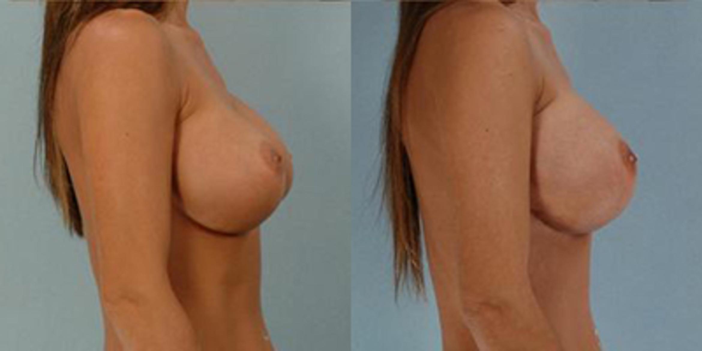 Before & After Breast Augmentation Case 4714 View 3 View in Houston, TX