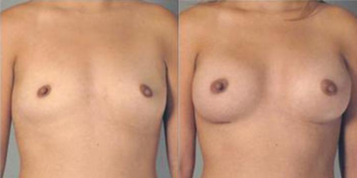 Before & After Breast Augmentation Case 4722 View 1 View in Houston, TX