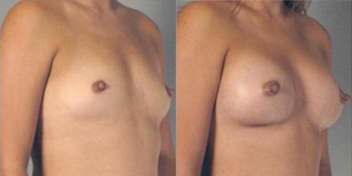 Before & After Breast Augmentation Case 4722 View 2 View in Houston, TX