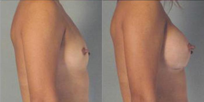 Before & After Breast Augmentation Case 4722 View 3 View in Houston, TX