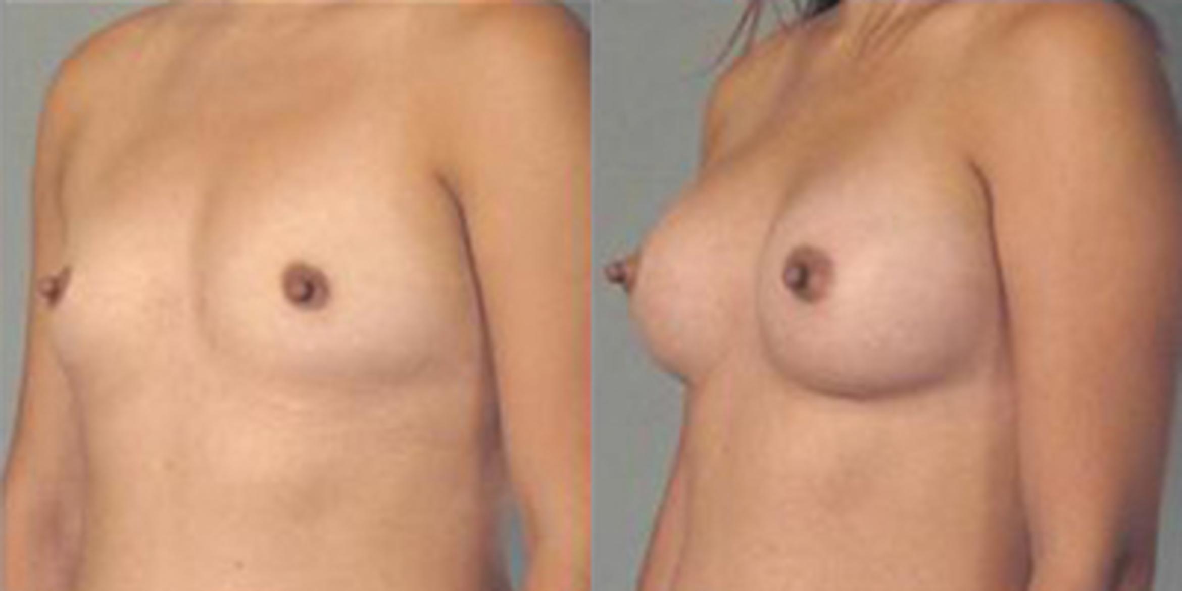 Before & After Breast Augmentation Case 4722 View 4 View in Houston, TX