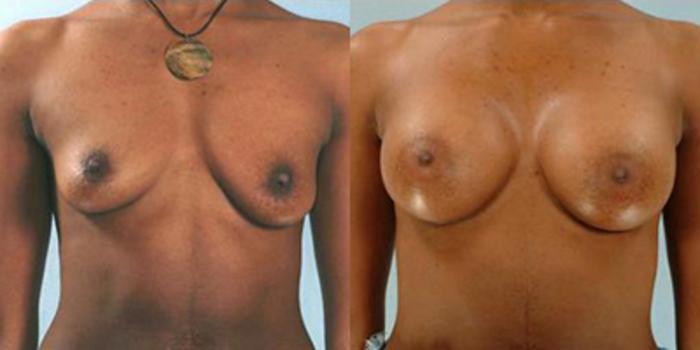 Before & After Breast Augmentation Case 4732 View 1 View in Houston, TX
