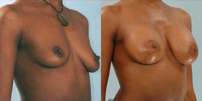 Before & After Breast Augmentation Case 4732 View 2 View in Houston, TX