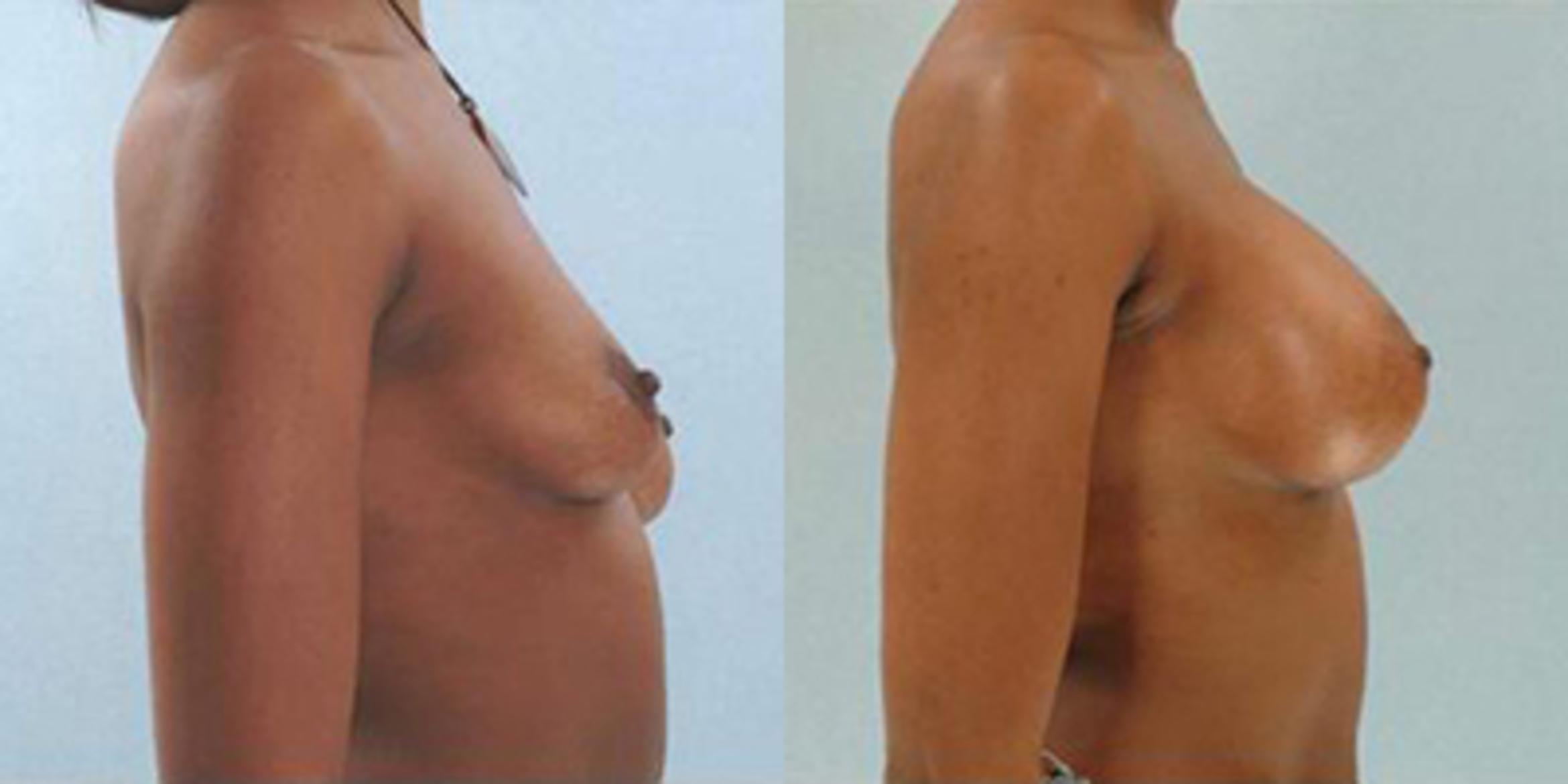 Before & After Breast Augmentation Case 4732 View 3 View in Houston, TX