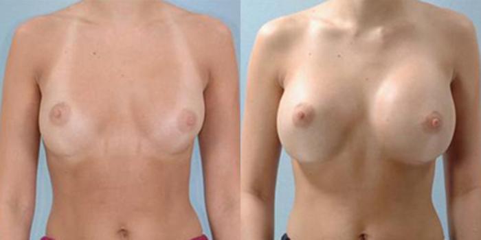 Before & After Breast Augmentation Case 4748 View 1 View in Houston, TX