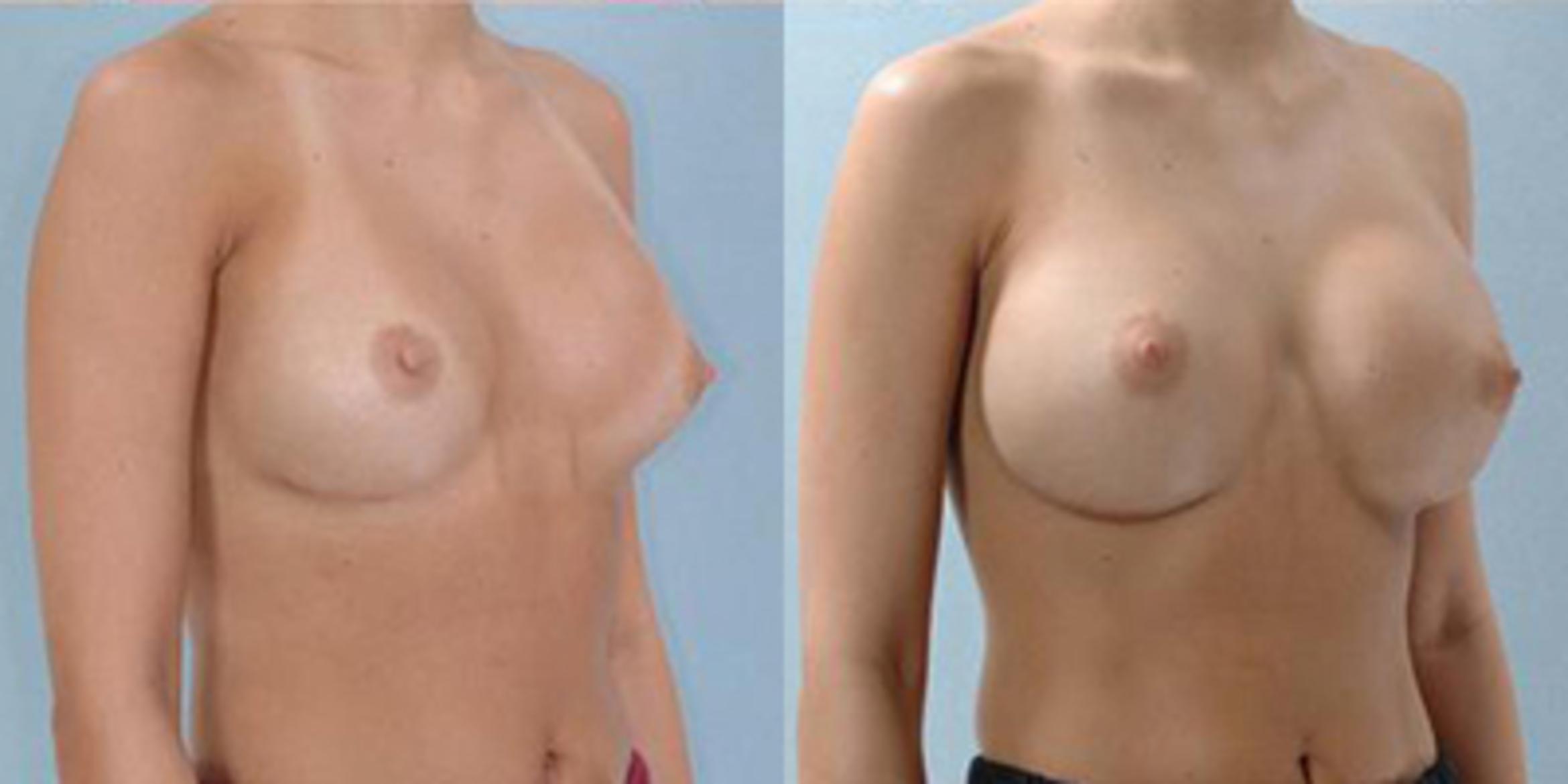 Before & After Breast Augmentation Case 4748 View 2 View in Houston, TX
