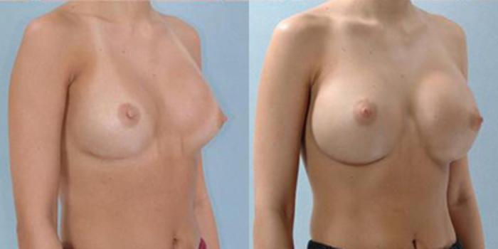 Before & After Breast Augmentation Case 4748 View 2 View in Houston, TX