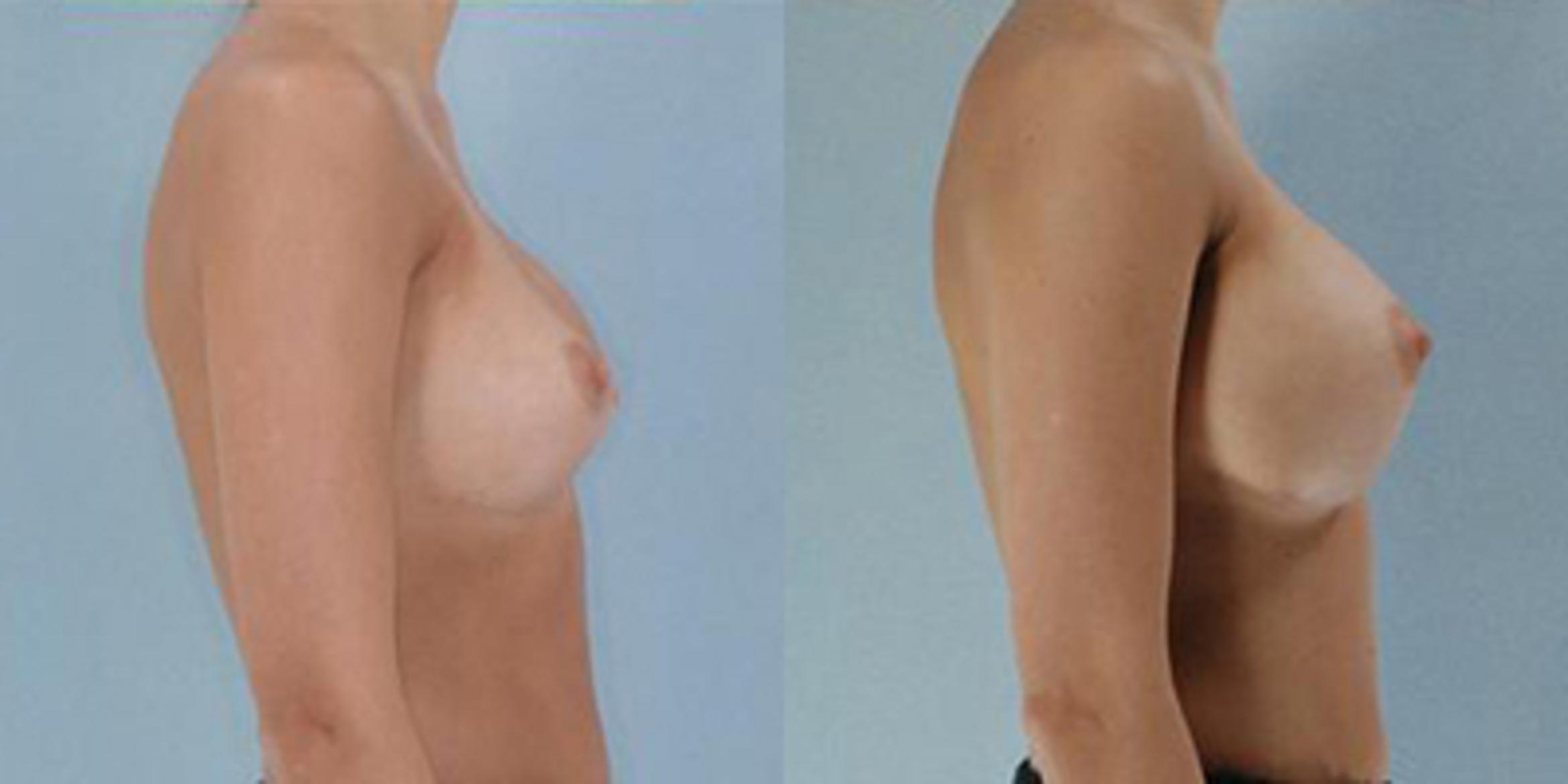 Before & After Breast Augmentation Case 4748 View 3 View in Houston, TX