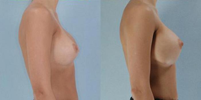 Before & After Breast Augmentation Case 4748 View 3 View in Houston, TX